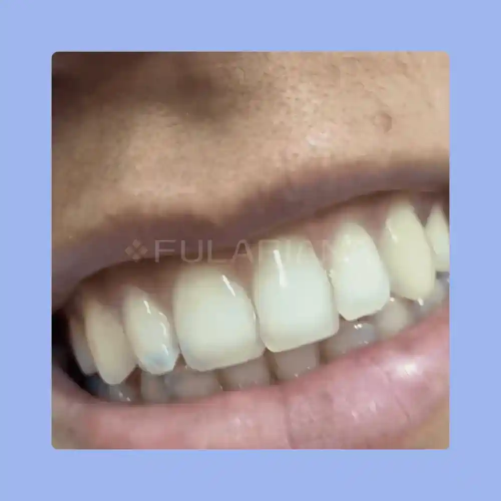 GIF BLANQUEAMINETODENTALVICENTE 21 ezgif.com optiwebp