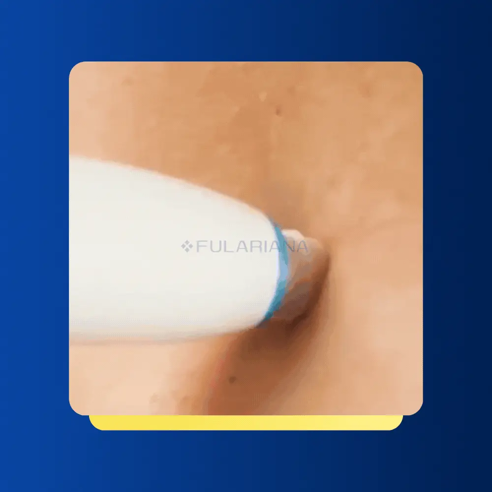 Parche Quita Verrugas 5 GIF1PARCHEQUITAVERRUGASVICENTE ezgif.com gif to webp converter